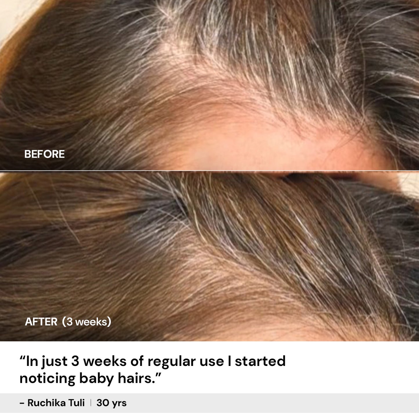 50ml $$** Hair growth serum before and after – visible baby hair growth in 3 weeks with CITTA Hair Growth Serum
