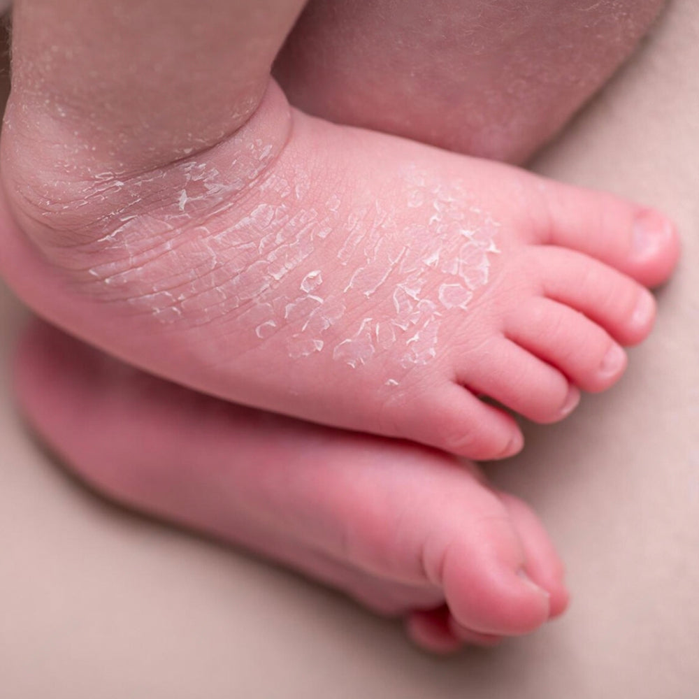 Newborn Skin Peeling: Causes and How to Treat It?