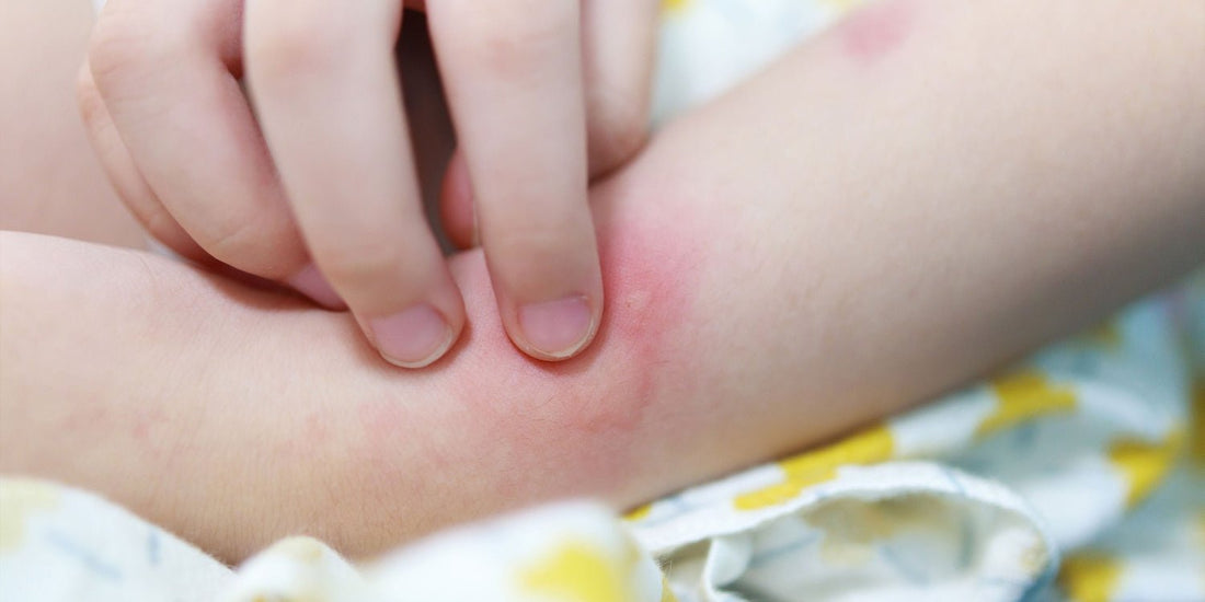 Tm7 Rash Baby Swaddling Rashes in Summer: Causes, Prevention & Relief Tips