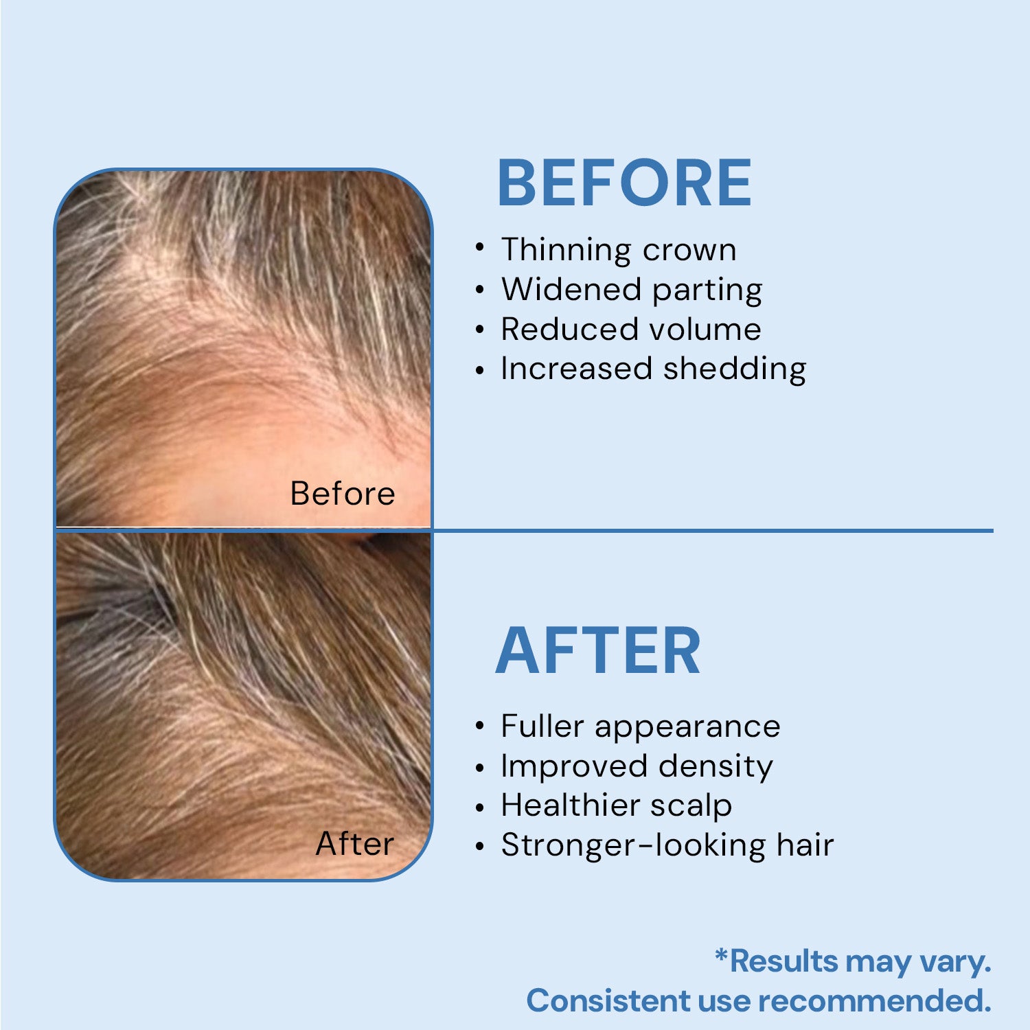 Hair Growth Serum with 3% Redensyl, 2% Anagain & Rosemary | For Hair Fall Control & Thickness