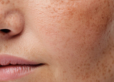 Pigmentation & Dark Spots